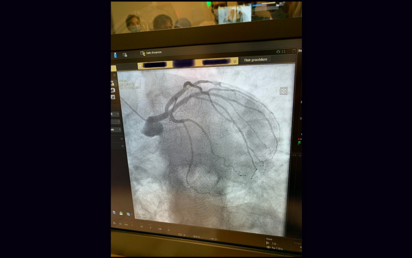 Un cliché issu de l'appareil de coronarographie. 